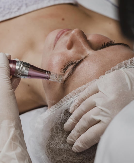 Microagulhamento Automatizado