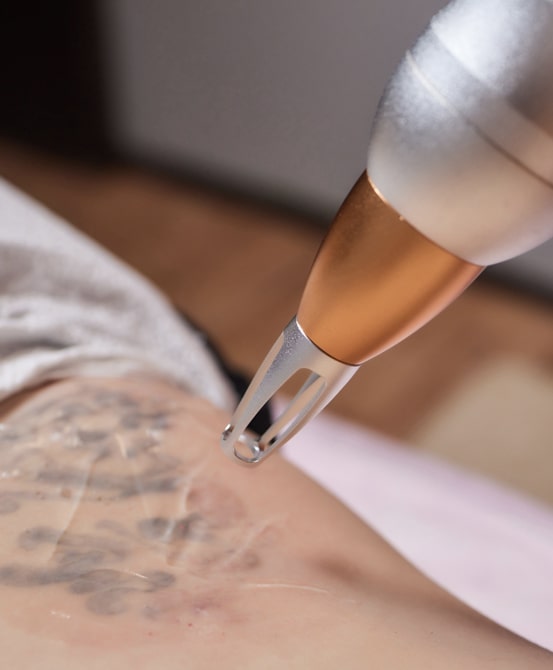 Remoção de tatuagem